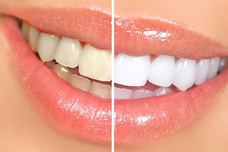 Blanqueamiento dental, clínica dental en Arteixo