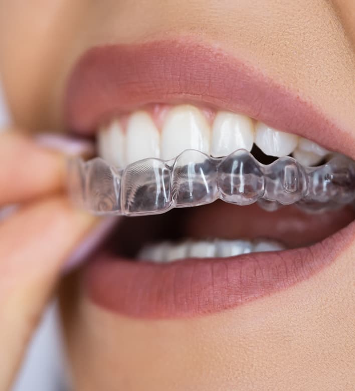  Corrige la posición de tus dientes y luce tu sonrisa